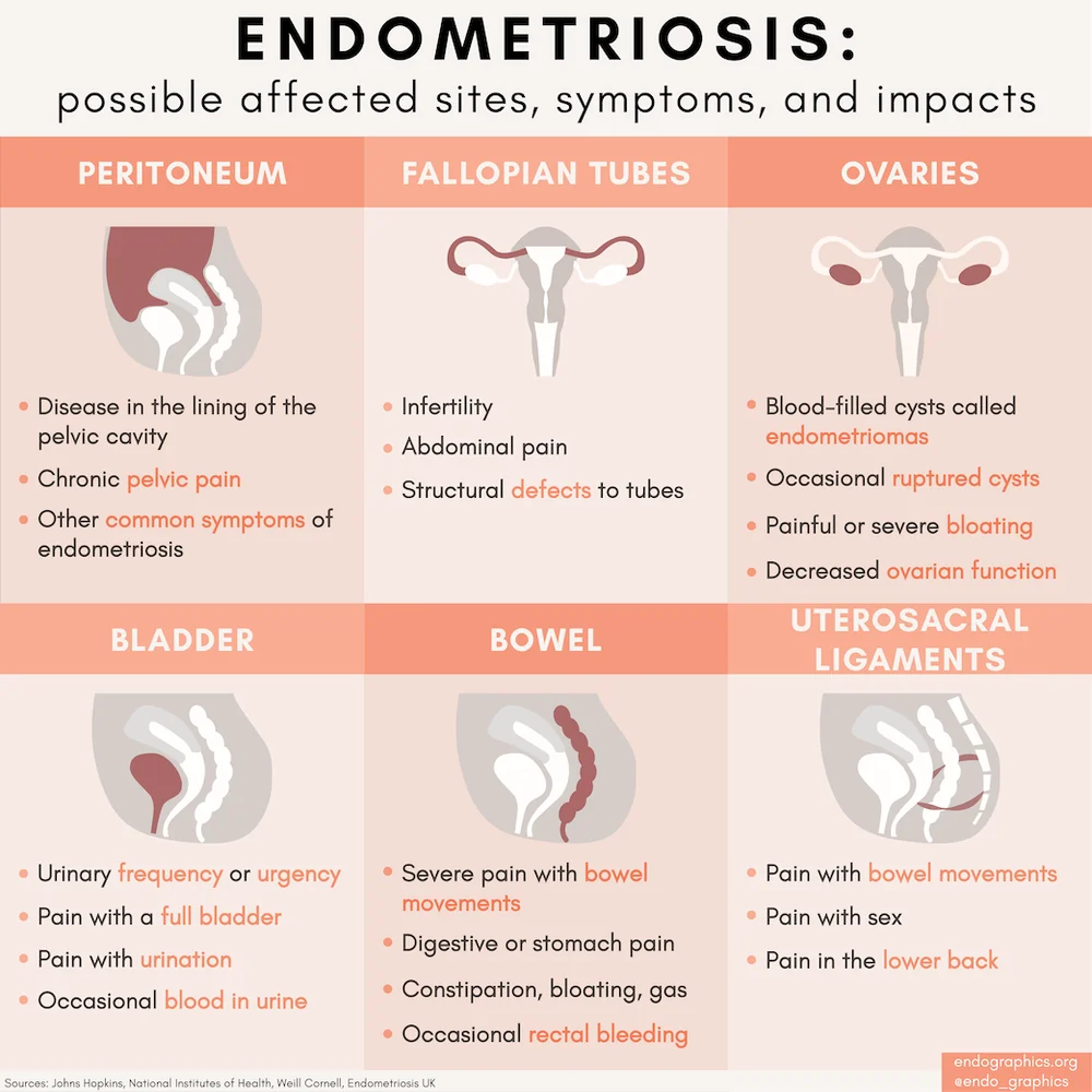 Endometriosis: possible affected sites, symptoms, and impacts. Infographic
