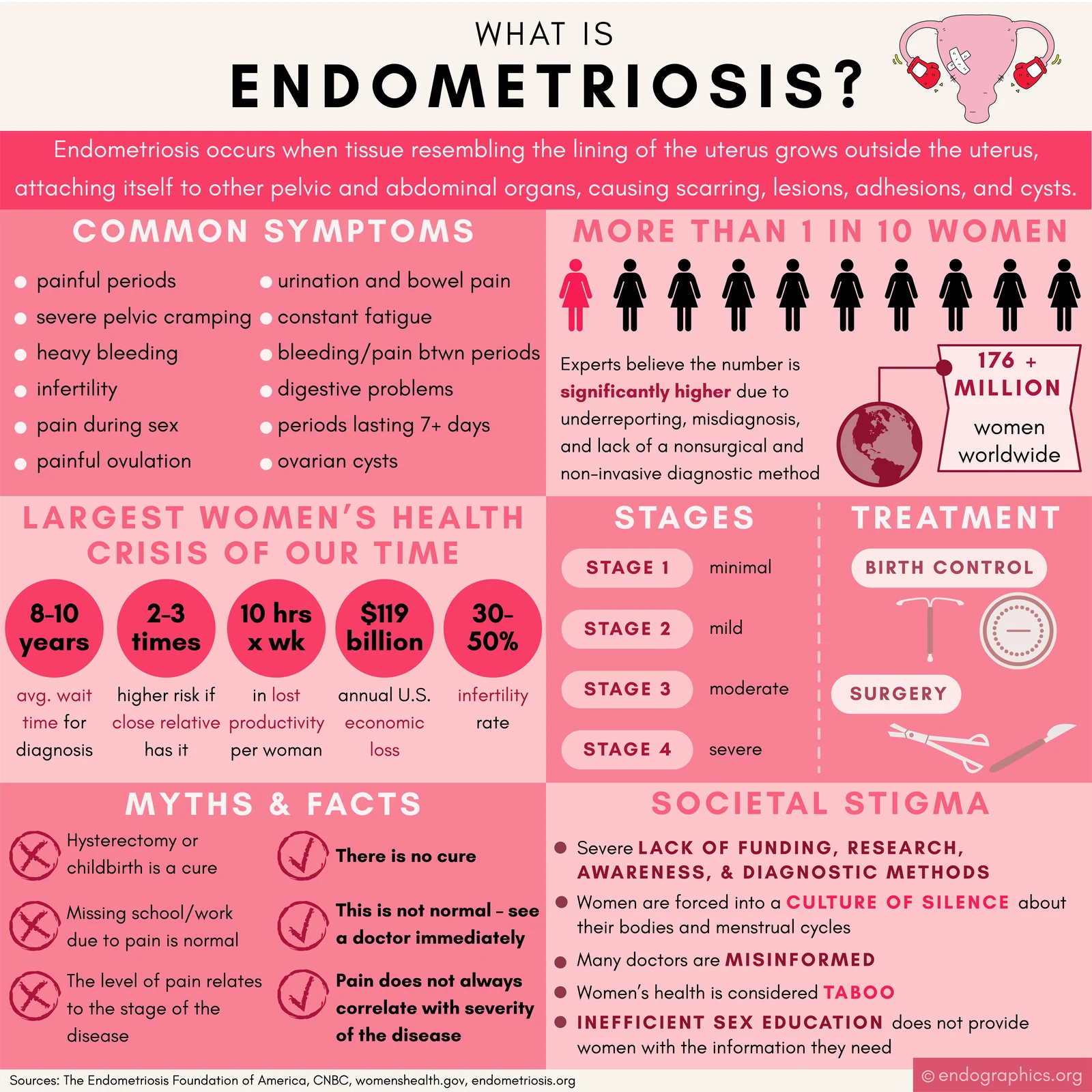 Infographic titled What is endometriosis? It covers common symptoms, how many women are affected, stages, treatment, myths and facts, and societal stigma.